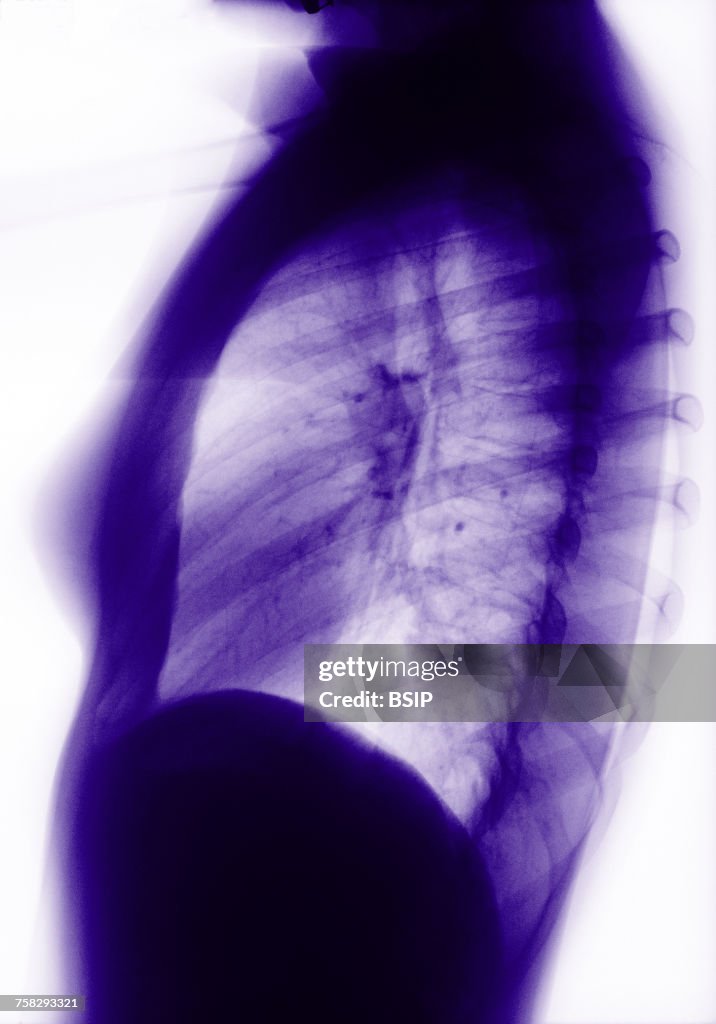 Lung,x-ray result