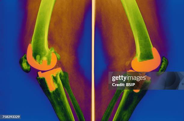 knee prosthesis,x-ray - knee replacement surgery foto e immagini stock