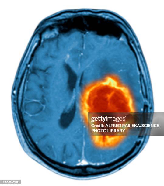 brain tumour, illustration - tumore metastatico foto e immagini stock