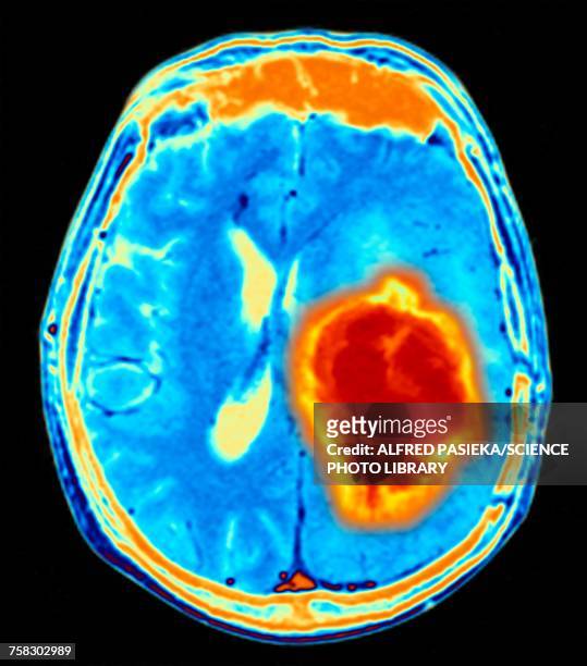 brain tumour, illustration - brain cancer stock pictures, royalty-free photos & images