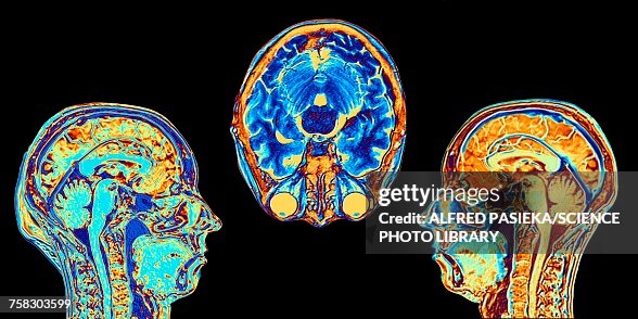 MRI scans of normal brains, illustration MRI scans of normal brains, illustration