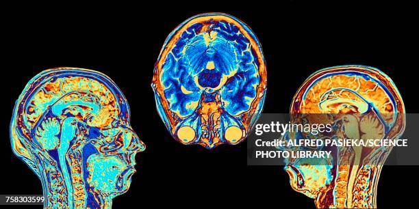 mri scans of normal brains, illustration - tronco cerebral imagens e fotografias de stock