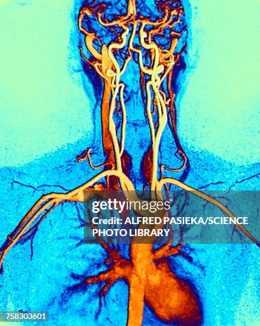 Chest, neck and head arteries, MRI scan Chest, neck and head arteries, MRI scan