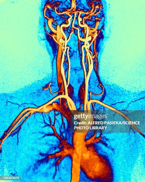 chest, neck and head arteries, mri scan - blood vessel stock illustrations