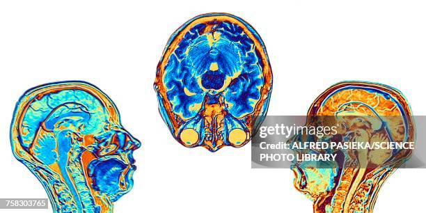mri scans of normal brains, illustration - neuroimaging stock pictures, royalty-free photos & images