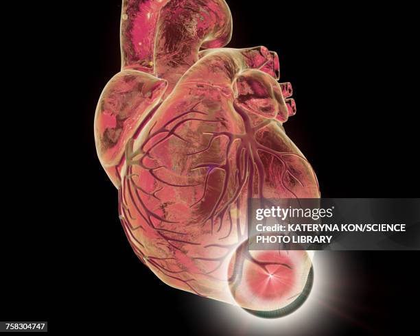 heart attack, conceptual illustration - necrosis stock illustrations