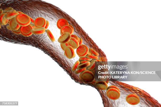 bildbanksillustrationer, clip art samt tecknat material och ikoner med narrowed blood vessel, illustration - ateroskleros