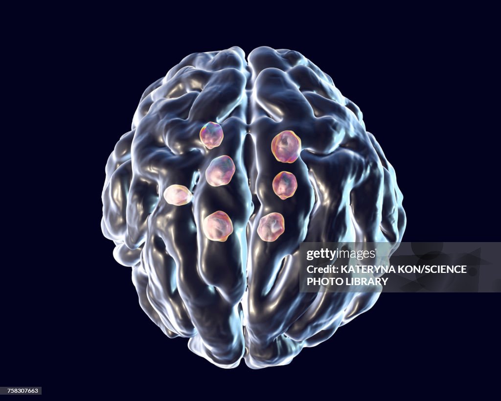 Cryptococcal brain lesions, illustration
