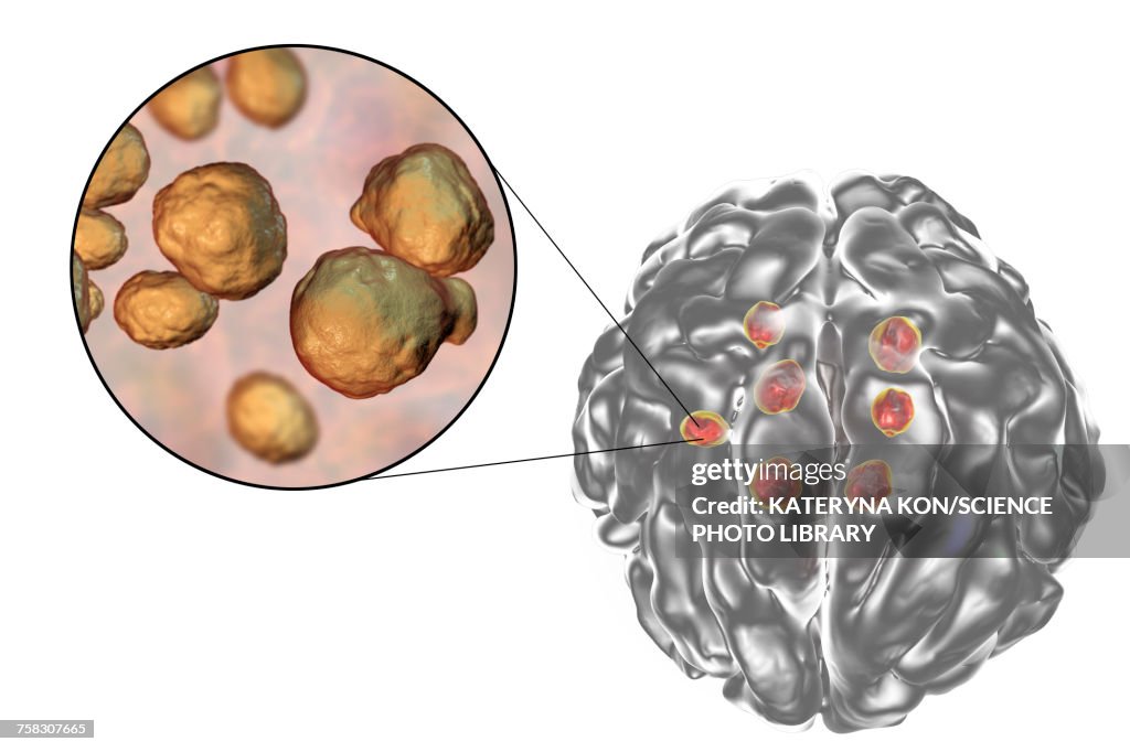 Cryptococcal brain lesions, illustration