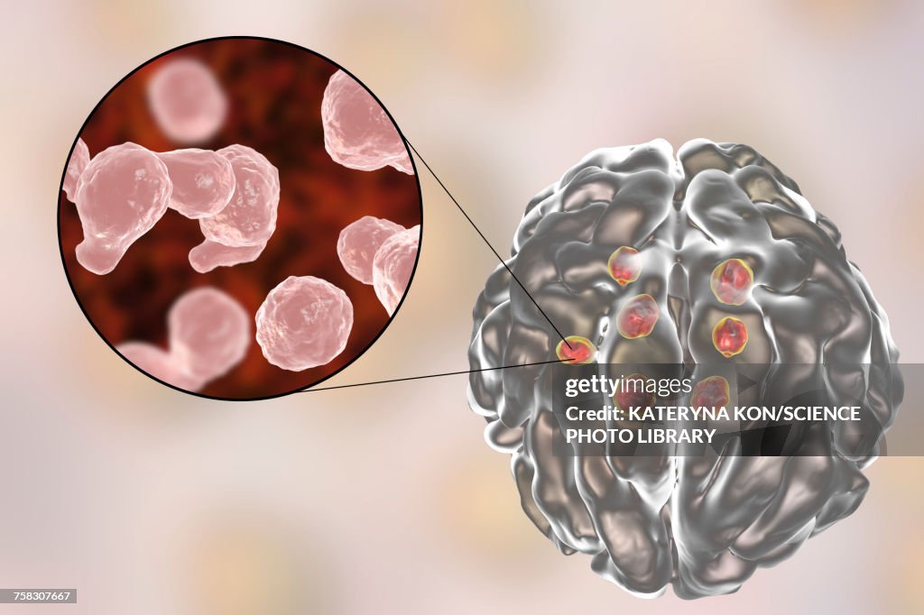 Cryptococcal brain lesions, illustration