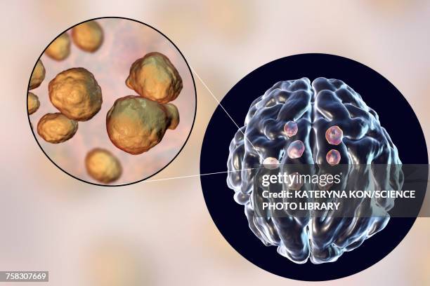 cryptococcal brain lesions, illustration - infected wound stock-grafiken, -clipart, -cartoons und -symbole