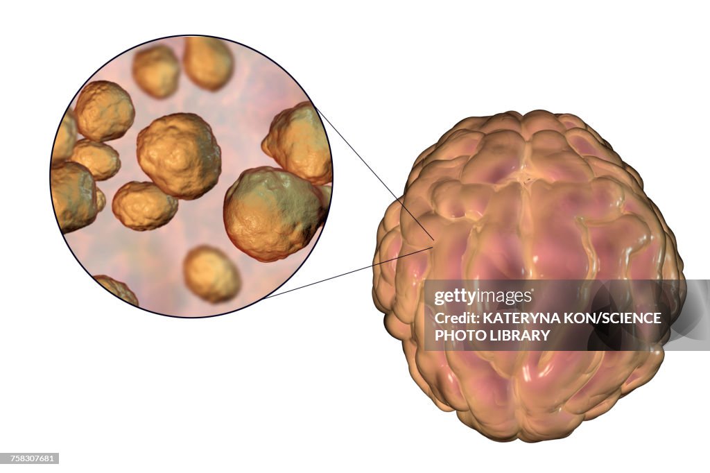 Cryptococcal meningitis, illustration