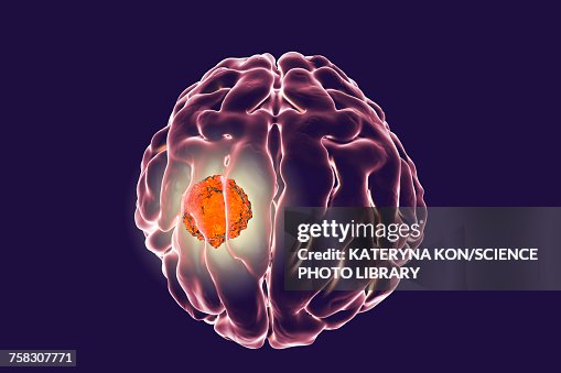 Brain Cancer Animation Brain Cancer Illustration High-Res Vector Graphic - Getty Images