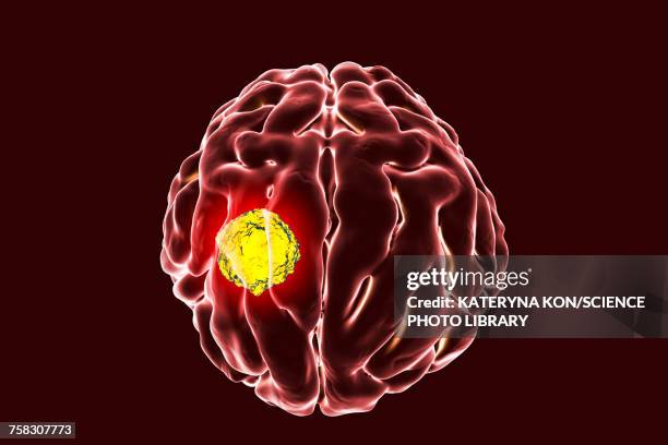 brain cancer, illustration - brain tumour stock illustrations