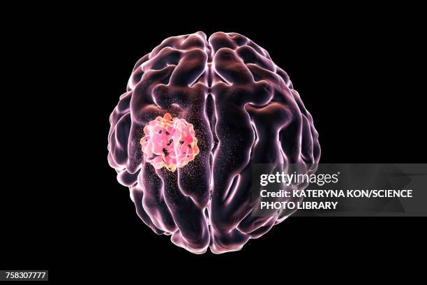 brain cancer treatment, illustration - brain tumour stock illustrations