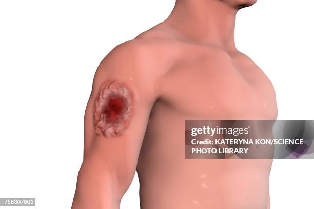 stockillustraties, clipart, cartoons en iconen met skin ulcer in leishmaniosis, illustration - leishmania