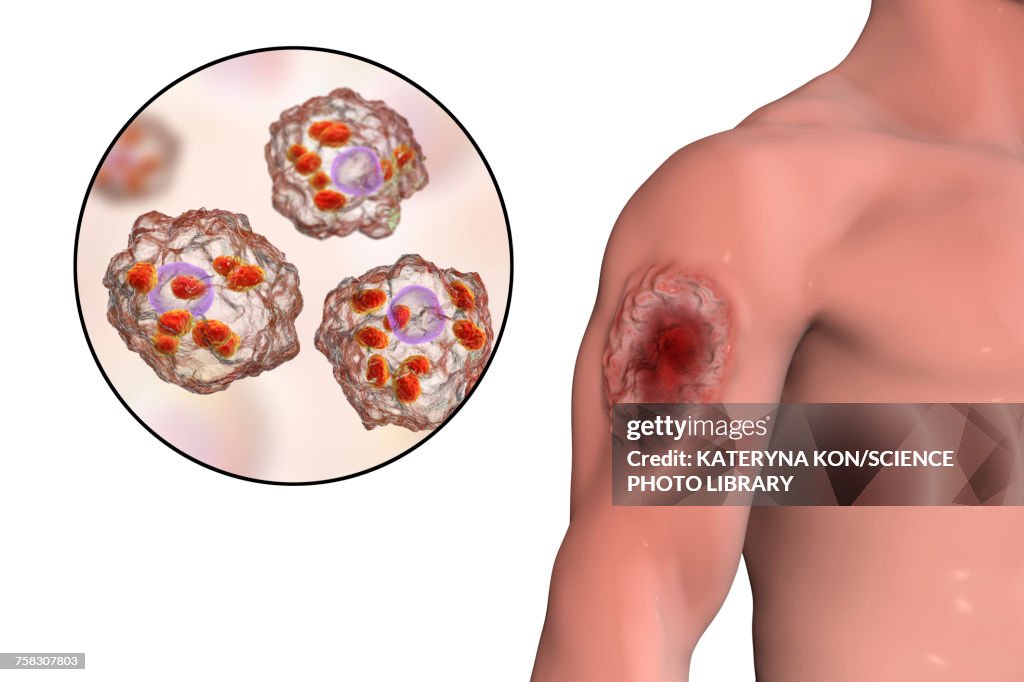 Skin ulcer in leishmaniosis, illustration