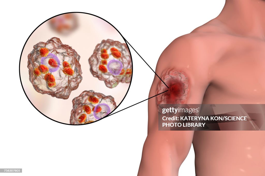 Skin ulcer in leishmaniosis, illustration