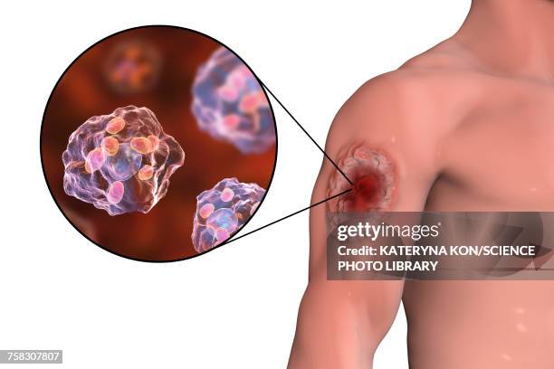 illustrazioni stock, clip art, cartoni animati e icone di tendenza di skin ulcer in leishmaniosis, illustration - ulcera
