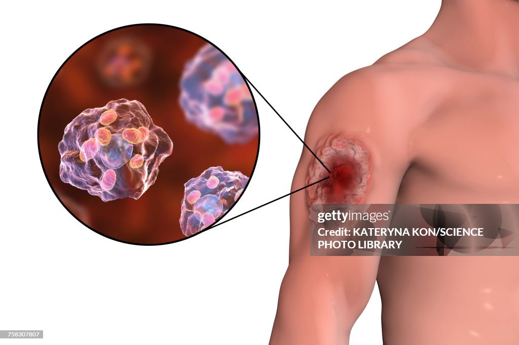Skin ulcer in leishmaniosis, illustration