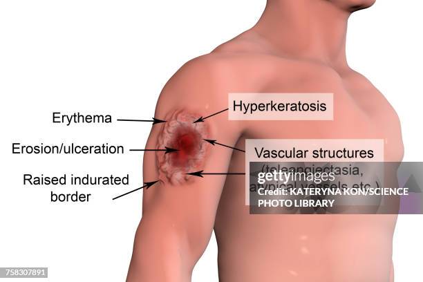 skin ulcer in leishmaniosis, illustration - ulcer_(dermatology) stock illustrations