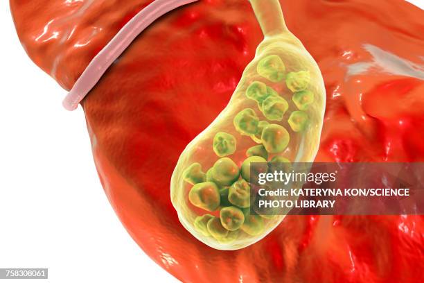 gallstones, illustration - gall bladder stock illustrations