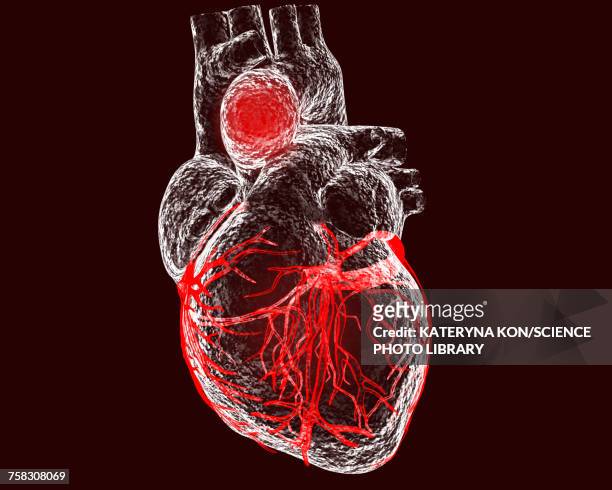 ilustraciones, imágenes clip art, dibujos animados e iconos de stock de aortic aneurysm, illustration - aorta