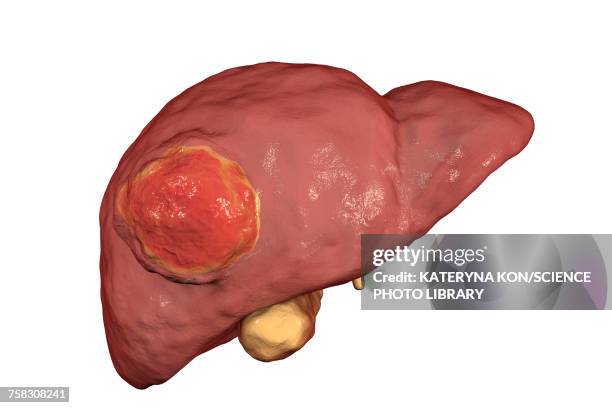 liver cancer, illustration - liver cancer stock-grafiken, -clipart, -cartoons und -symbole