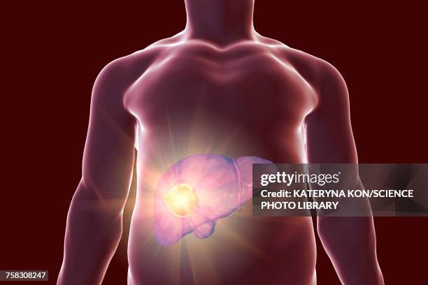 liver cancer treatment, conceptual illustration - liver cancer stock-grafiken, -clipart, -cartoons und -symbole