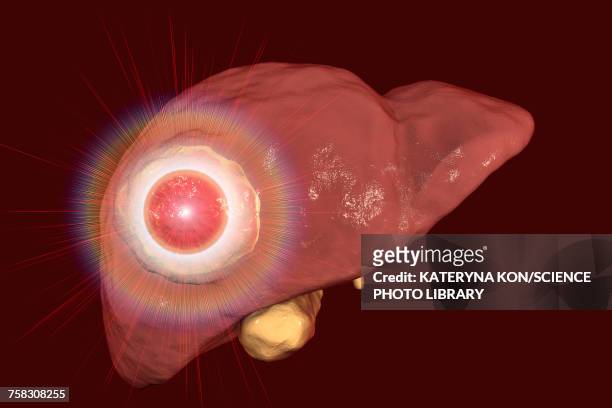 liver cancer treatment, conceptual illustration - liver cancer stock-grafiken, -clipart, -cartoons und -symbole