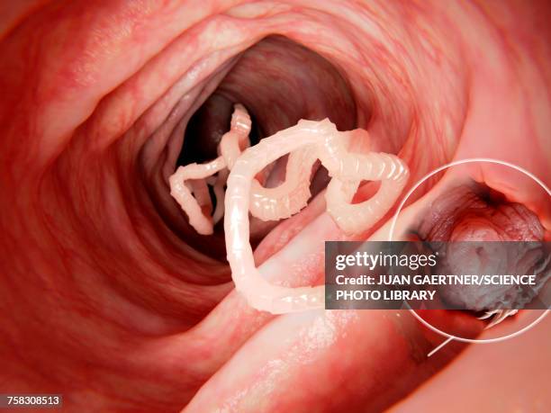 ilustrações, clipart, desenhos animados e ícones de tapeworm in human intestine, illustration - infestation