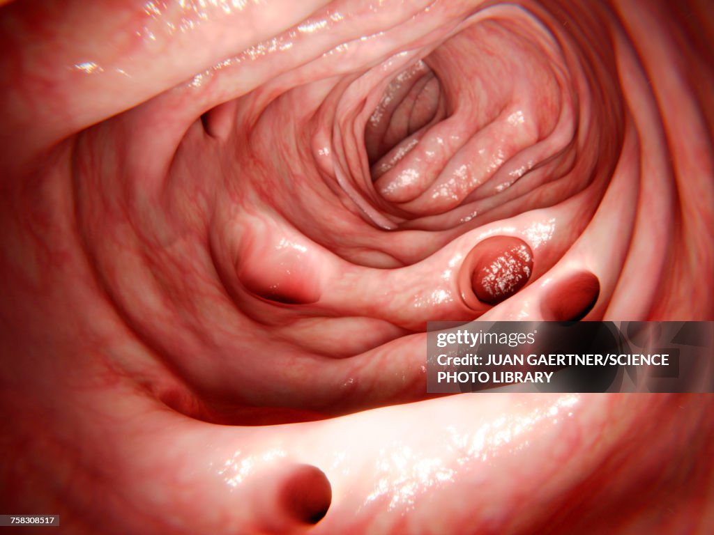 Diverticula in the large intestine, illustration