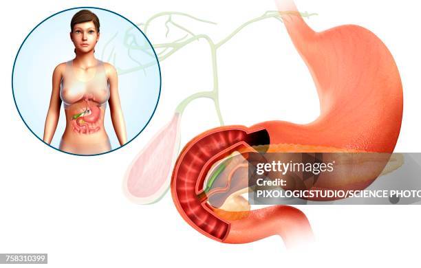 ilustraciones, imágenes clip art, dibujos animados e iconos de stock de gallbladder, duodenum and pancreas, illustration - duodeno