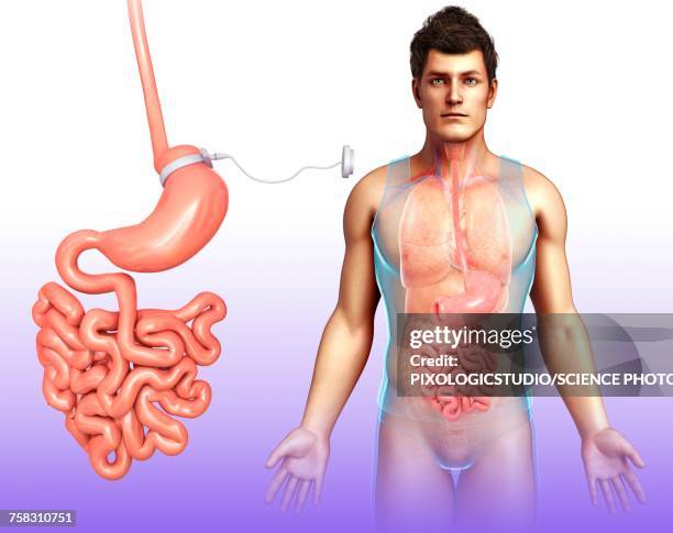 adjustable gastric band, illustration - abdomen surgery stock illustrations