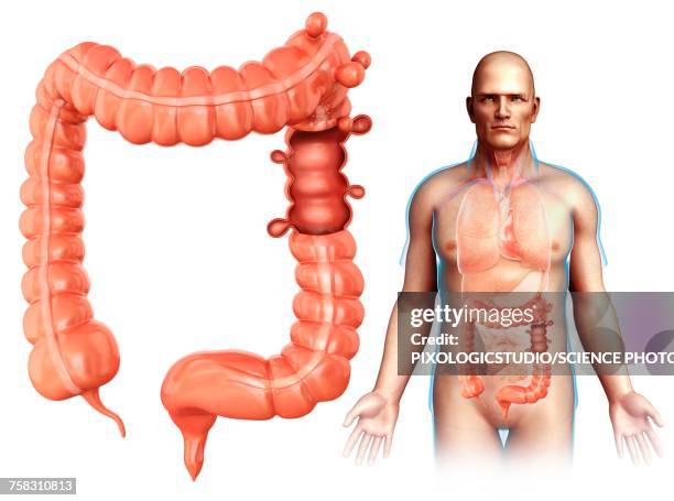 man with diverticulosis, illustration - diverticulosis stock illustrations