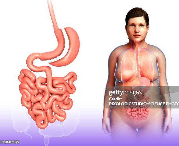 sleeve gastrectomy, illustration - bariatric stock illustrations