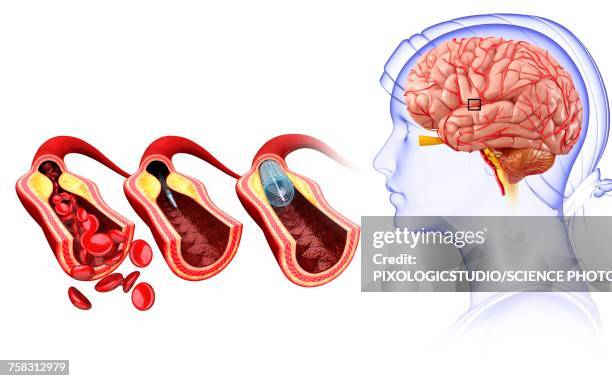 ilustrações, clipart, desenhos animados e ícones de stroke treatment, illustration - derrame cerebral