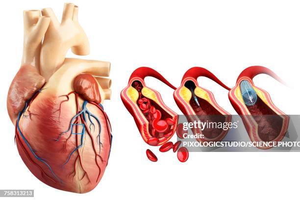 coronary angioplasty stent insertion, illustration - atherosclerosis stock illustrations