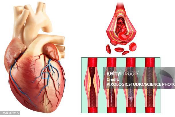 ilustrações, clipart, desenhos animados e ícones de coronary angioplasty stent insertion, illustration - artéria coronária