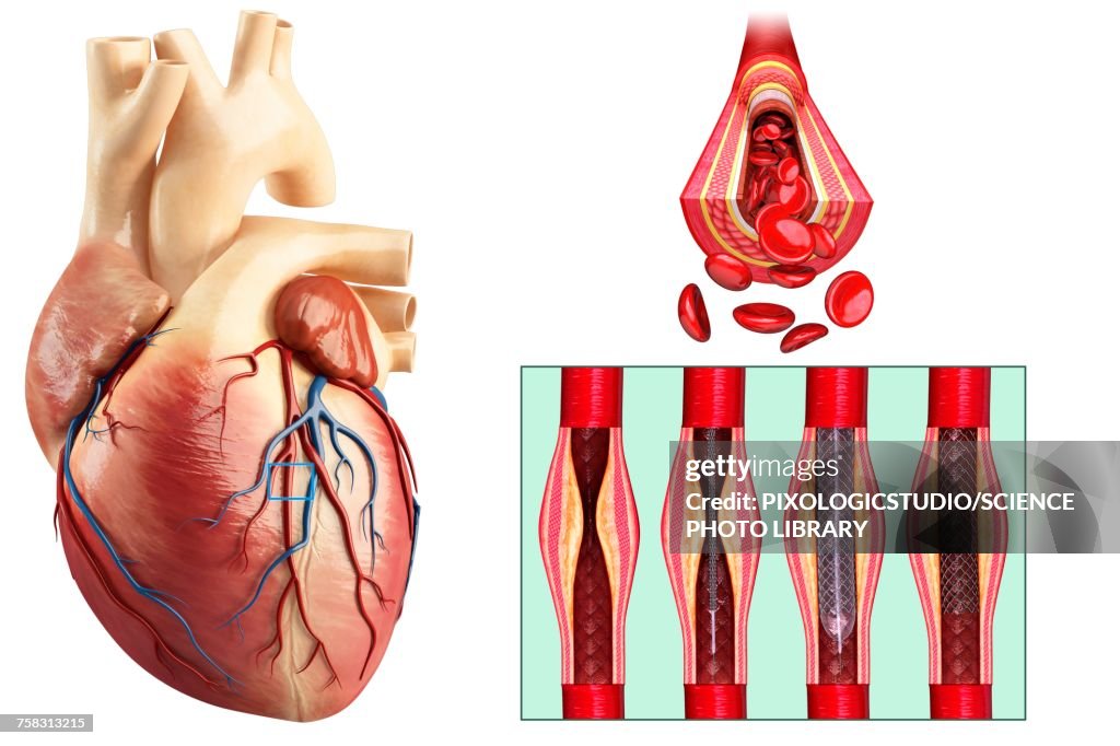 Coronary angioplasty stent insertion, illustration