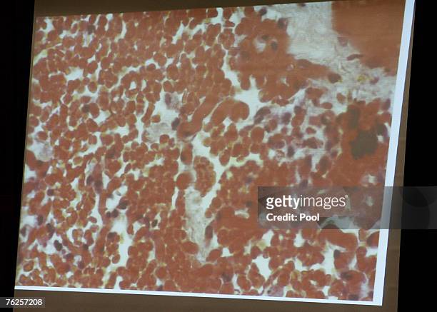 Photograph showing red blood cells and other cells in an air sac from the lung of Lana Clarkson, taken by witness, Dr. Werner Spitz, a forensic...