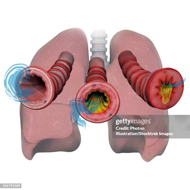 3d model of lungs and bronchioles depicting asthma airflow in various stages with inflammation and mucus. - mucus stock illustrations