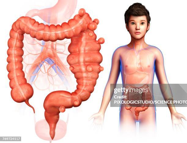 child with diverticulosis, illustration - diverticulosis stock illustrations