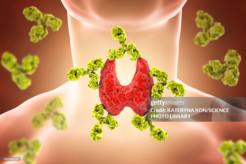 Autoimmune thyroiditis, conceptual illustration
