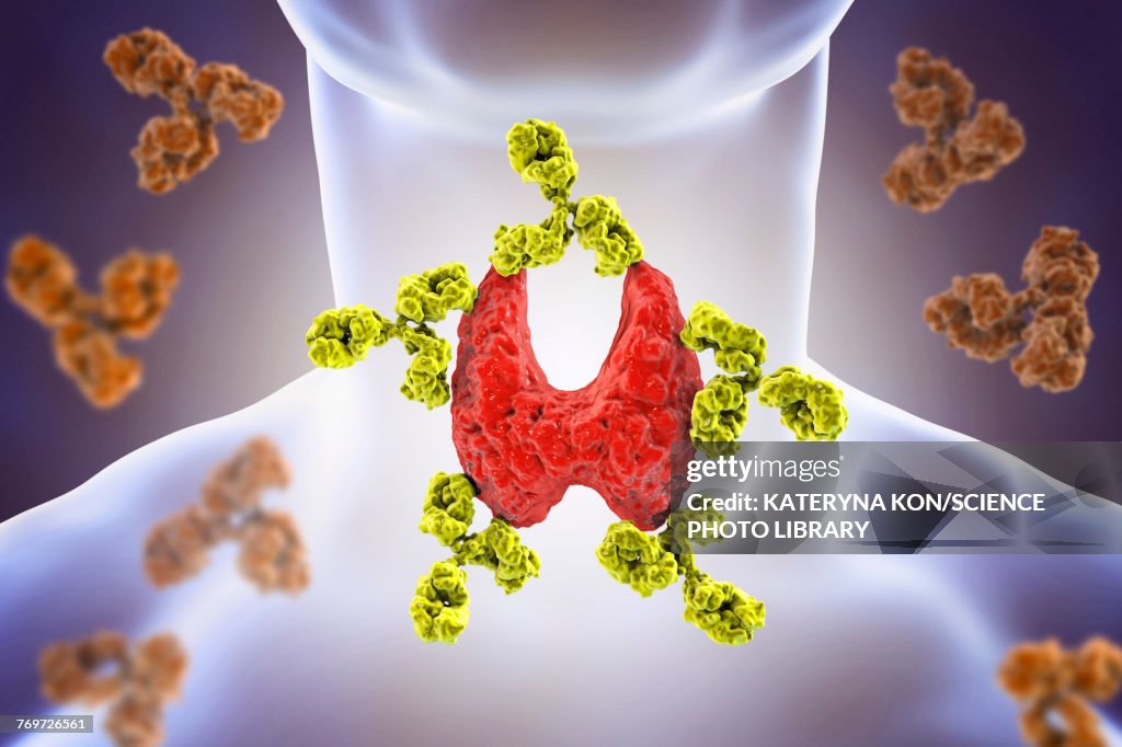Autoimmune thyroiditis, conceptual illustration
