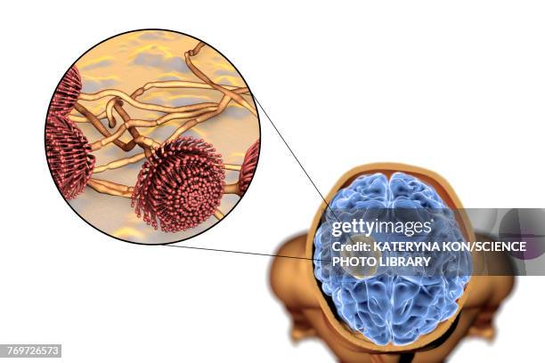 illustrations, cliparts, dessins animés et icônes de aspergilloma of the brain, illustration - aspergillus fumigatus