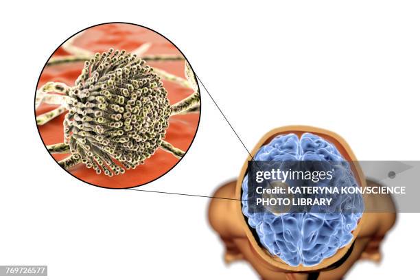 illustrations, cliparts, dessins animés et icônes de aspergilloma of the brain, illustration - aspergillus fumigatus