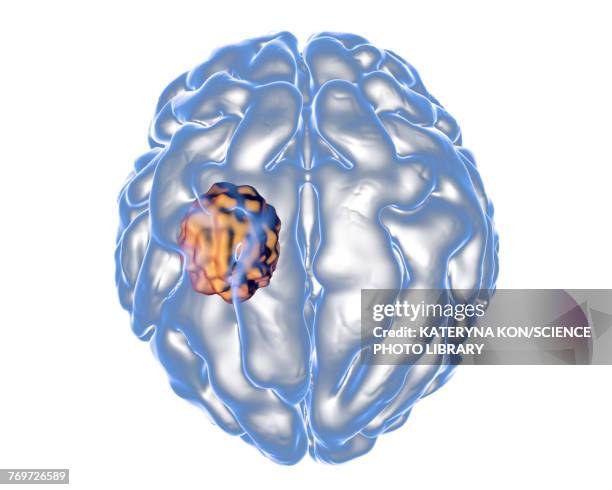 aspergilloma of the brain, illustration - aspergillus fumigatus stock illustrations