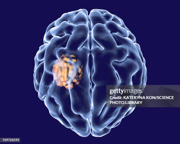 aspergilloma of the brain, illustration - aspergillus fumigatus stock illustrations