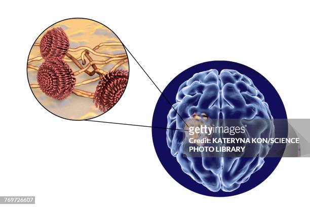 aspergilloma of the brain, illustration - aspergillus fumigatus stock illustrations